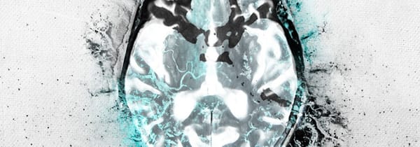 Le Nexus du Docteur Erdmann, mal au cerveau